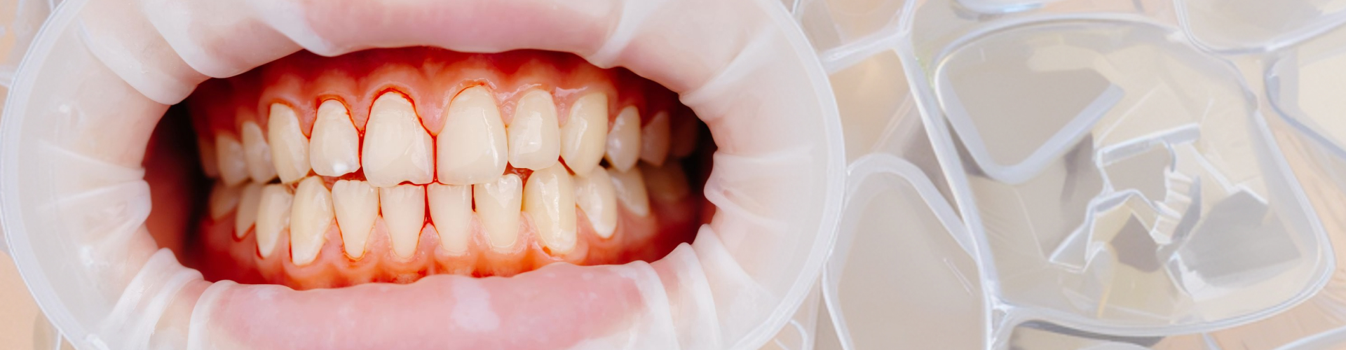 Close-up of inflamed red gums showing signs of gingivitis and early stage gum disease.